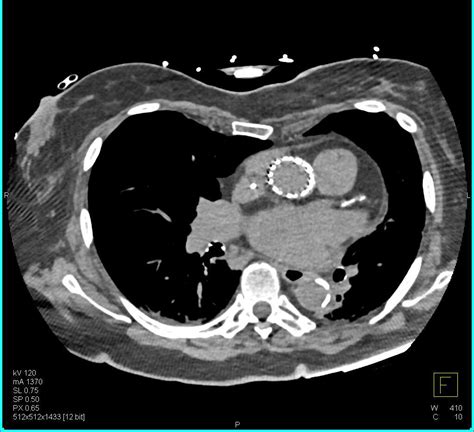 Tavr Repair Ascending Aorta In 3d Vascular Case Studies Ctisus Ct