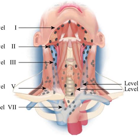 The System Of Lymph Node Levels In The Neck As Described By Robbins Et