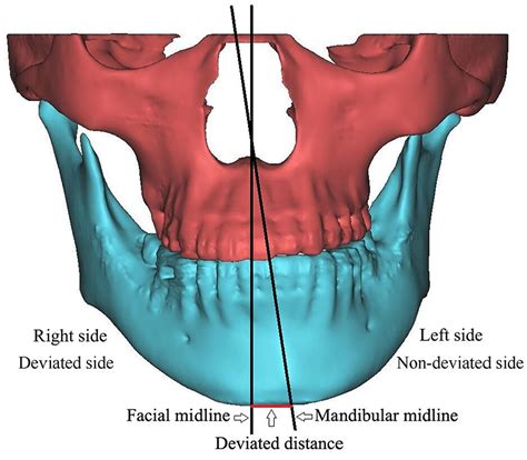 The Relations Between The Stress In Temporomandibular Joints And The