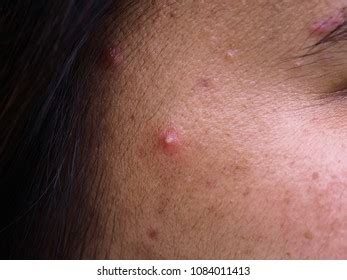Dermatological Disease Acne Acne On Face Stock Photo Shutterstock