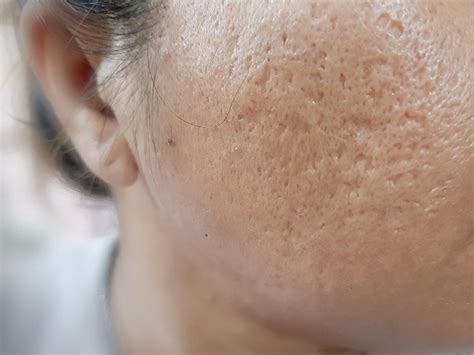 How To Get Rid Of Boxcar Scars Treatments For Acne Scars
