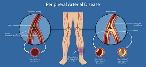 Peripheral Artery Disease Acute Pain In Chest And Leg Are Signs Of Pad