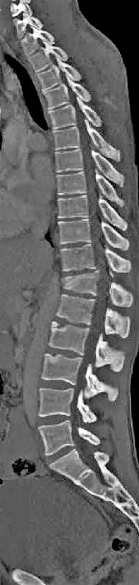 Full Length Spine Ct And Mri In Daily Practice Radiology Key