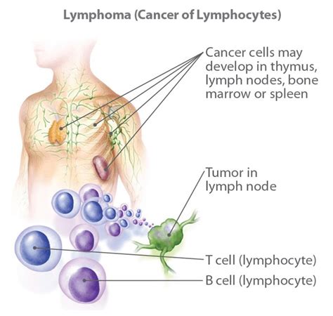 Cancer Limfatic Simptome Cauze Limfomul Hodgkin Cauze Simptome My Xxx