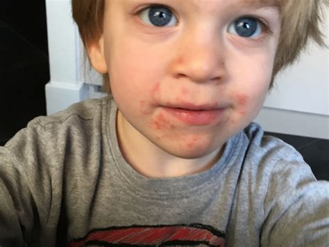 What Is This Rash On My Toddlers Face See Pic Mumsnet