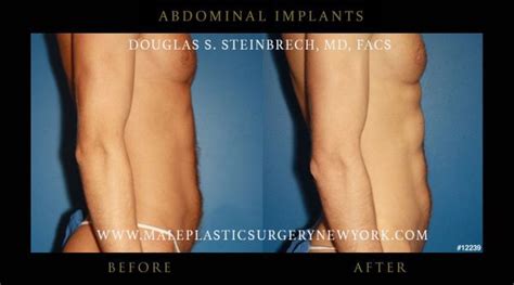 Abdominal Implants Male Plastic Surgery Chicago