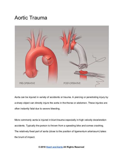 Heart And Aorta ﻿aortic Trauma Quiosco Joomag