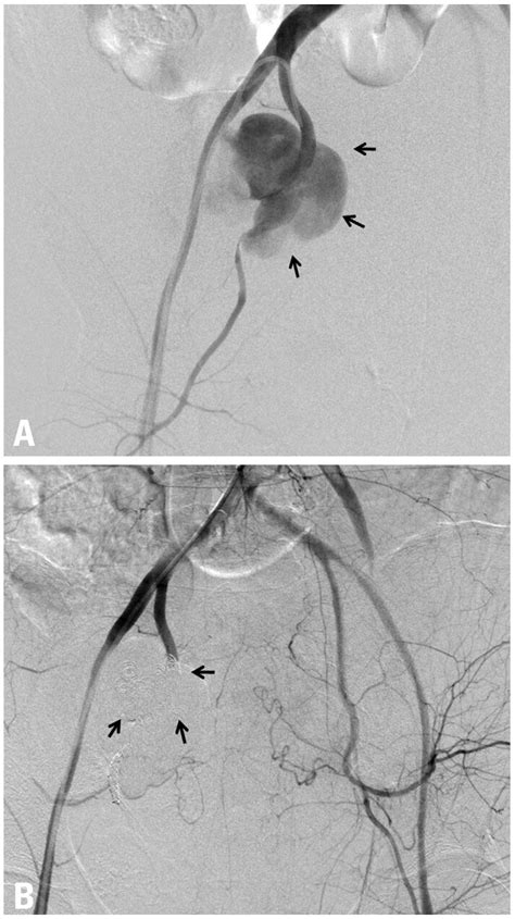 A The Angiography Showing Active Extravasation From The Right