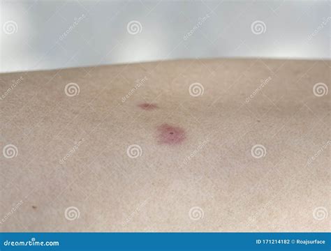 Small Insect Bite Human Arm Skin Itching Allergy Red Spot Blister