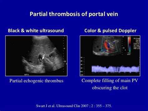 Doppler Ultrasound Of Portal Vein Thrombosis