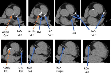 Calcium Scoring For Cardiovascular Computed Tomography Radiologic Clinics
