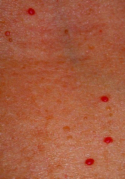 Pinpoint Red Dots On Skin Not Itchy Moliintra
