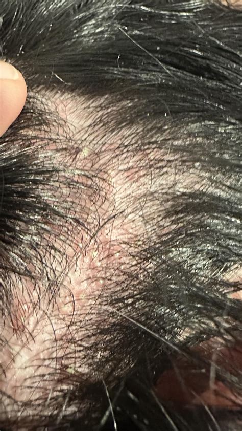Painful Bumps Over Most Of My Scalp What Is This Popped Up 2 Days Ago