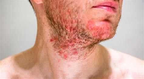 Is Folliculitis Contagious Types Causes And Prevention Page 10 Of