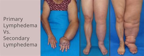 The Difference Between Primary And Secondary Lymphedema Artofit