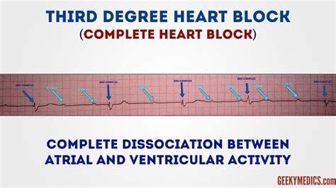 Therefore, complete dissociation of the atrial and ventricular activity exists. How to Read an ECG | ECG Interpretation | EKG | Geeky Medics