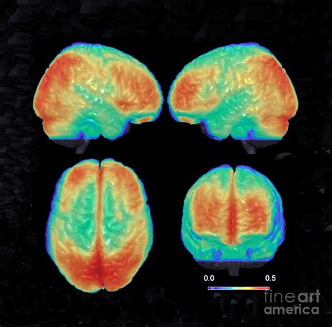 Bipolar Brain D Mri Scan Photograph By Science Source Pixels