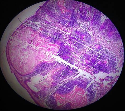 Squamous Inclusion Cyst In The Palatine Tonsil Mimicking A Tumor