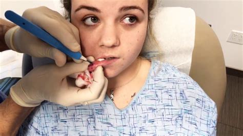 Pin By Dianna Hubbs Beeler Barton On Cyst Removal Inside Mouth Cysts