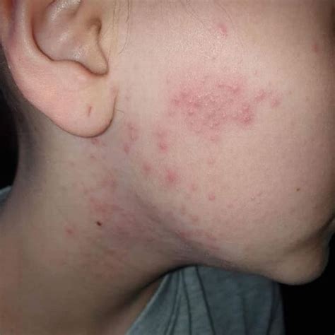 Covid Rash In Kids Skin Rashes Are Possible Rare Symptom Of The