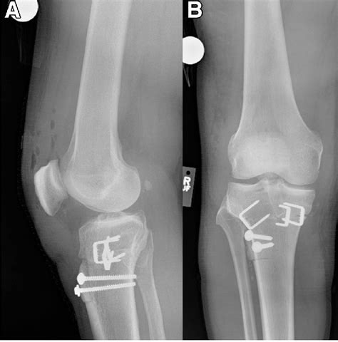 Postoperative Day 1 Right Knee Radiographs Following Anterior Closing