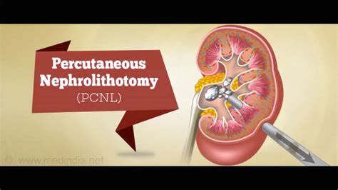 Stone removal can be done by a traditional. Kidney Stone Removal - Percutaneous Nephrolithotomy (PCNL ...