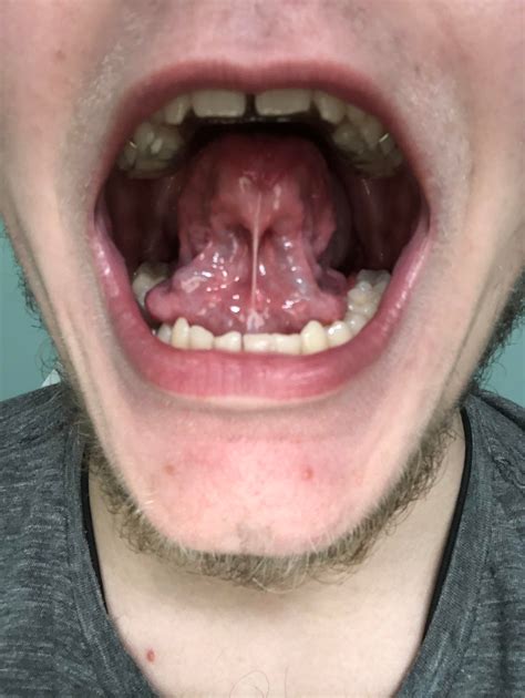 Do I have to cut my tongue tie to mew properly? : orthotropics