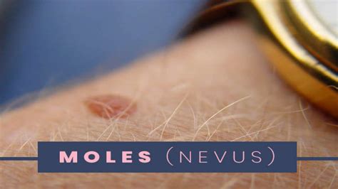 Moles Types Causes Symptoms Risk Factors Treatments And Prevention