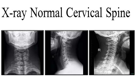 X Ray Normal Cervical Spine Anatomy Youtube