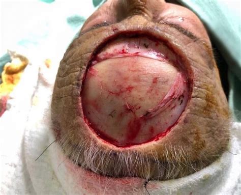 Case Of Mohs Surgery For An Extensive Forehead Squamous Cell Carcinoma