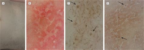 Dermoscopic Subpatterns Of Ashy Dermatosis Related To Lichen Planus