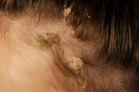 Treating Psoriasis On The Scalp Hairline Forehead Behind The Ears And Back Of The Neck