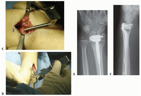 Intramedullary And Dorsal Plate Fixation Of Distal Radius Fractures