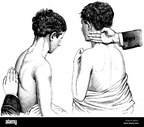 An Engraving Depicting A Swedish Massage Back And Shoulder Chopping Dated 19th Century Stock