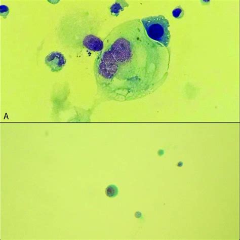 Csf Fluid Pathology With A Large Atypical Cells With Irregular
