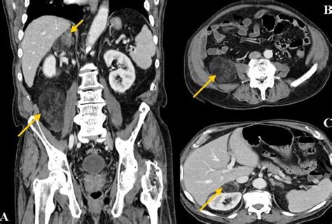 Simultaneous Adrenal And Extra Adrenal Myelolipoma An Uncommon
