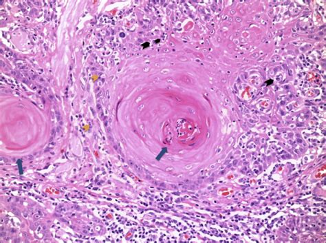Histologic Image Of Oral Squamous Cell Carcinoma Hematoxylin Eosin
