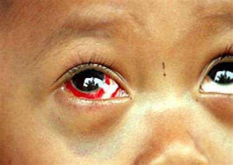 Bloodshot Eyes In Children Causes And Remedies