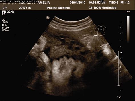 Henretty Happenings Ultrasound Pictures 31 Weeks