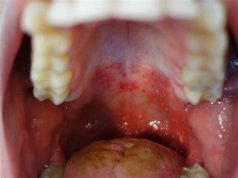 Erythroplakia Roof Of Mouth