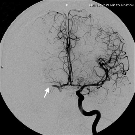 Recanalization Of An Acute Middle Cerebral Artery Occlusion Using A Self Expanding
