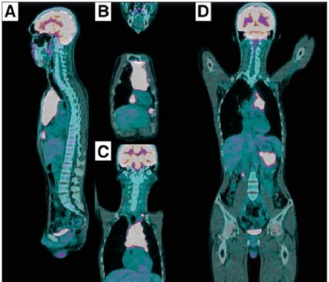 Petct Performed Before The Treatment For Malignant Lymphoma Abnormal