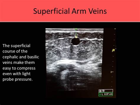 Ultrasound Registry Review Extremity Venous Sonography School Cardiac Sonography Arm Veins