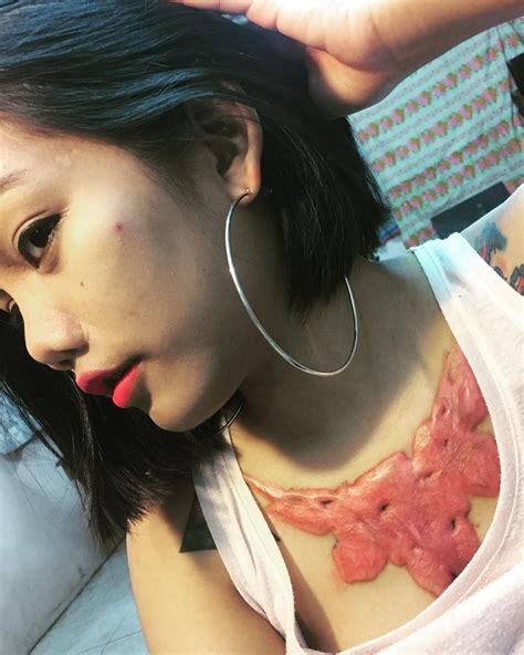 Woman Uses Tattoo Removal Cream On Her Chest Resulting In Horrific Scar