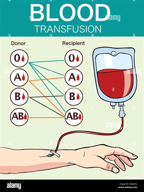 Vector Illustration Einer Bluttransfusion Stock Vektorgrafik Alamy
