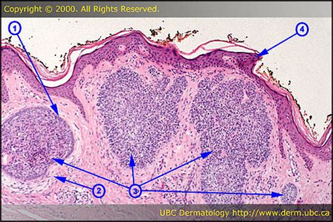 Peripheral Palisading Basal Cell Carcinoma Histology Braun Free Glider