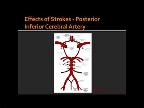 Effects Of Strokes Posterior Inferior Cerebral Artery YouTube