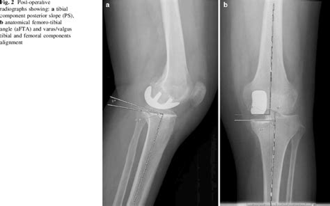 Post Operative Radiographs Showing A Tibial Component Posterior Slope