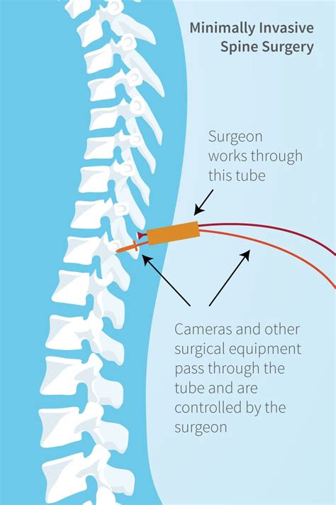 Minimally Invasive Spine Surgery Miss By Dr Susmit Naskar Medium