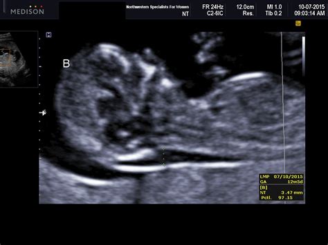 What Does Nuchal Nt Mean Nuchal Translucency Scan During Pregnancy